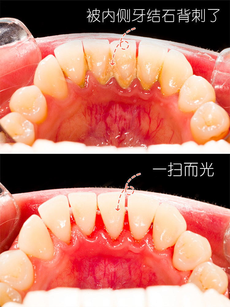 💫宝藏洁牙体验｜人均￥50+get白领同款笑容！案例图片 2