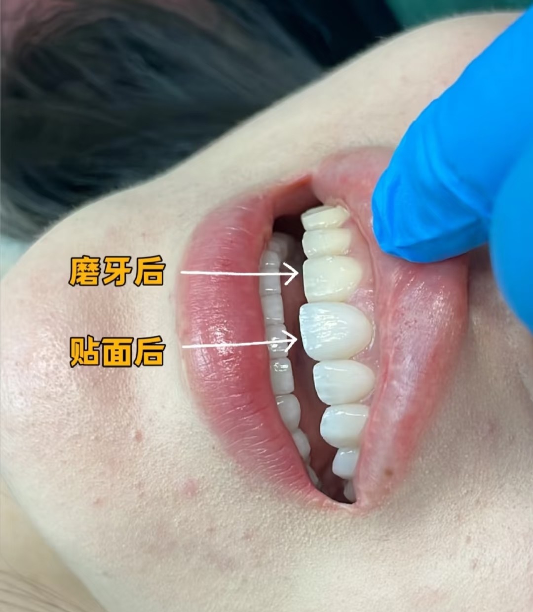 牙贴面材质怎么选？🌟案例图片 1
