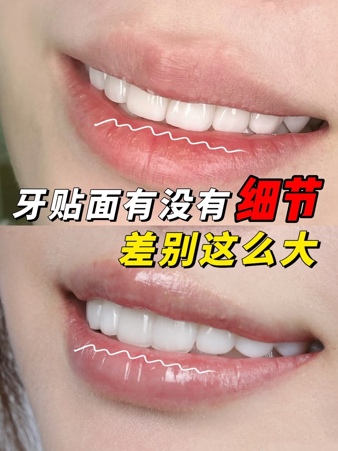 牙贴面效果太绝了！前后差距惊到我了✨案例图片 2