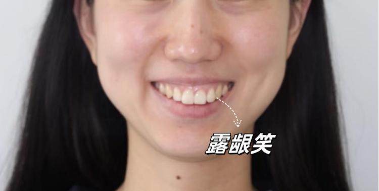 笑不活了！原来女明星的微笑线是这样练成的！案例图片 2