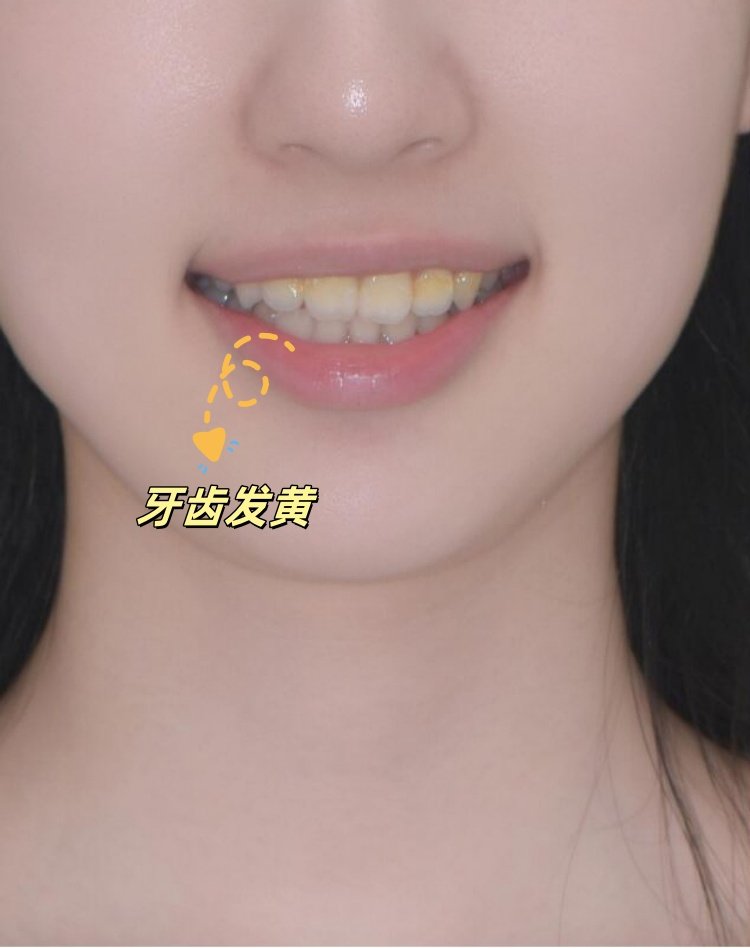 😣23岁黄牙女孩的贴面逆袭：从&ldquo;咖啡牙&rdquo;到&ldquo;妈生白&rdquo;全记录案例图片 2