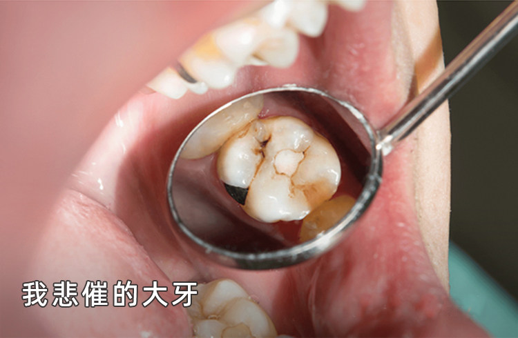拖延症患者含泪总结：补牙真的越早越好！我的血泪史+避坑指南案例图片 2