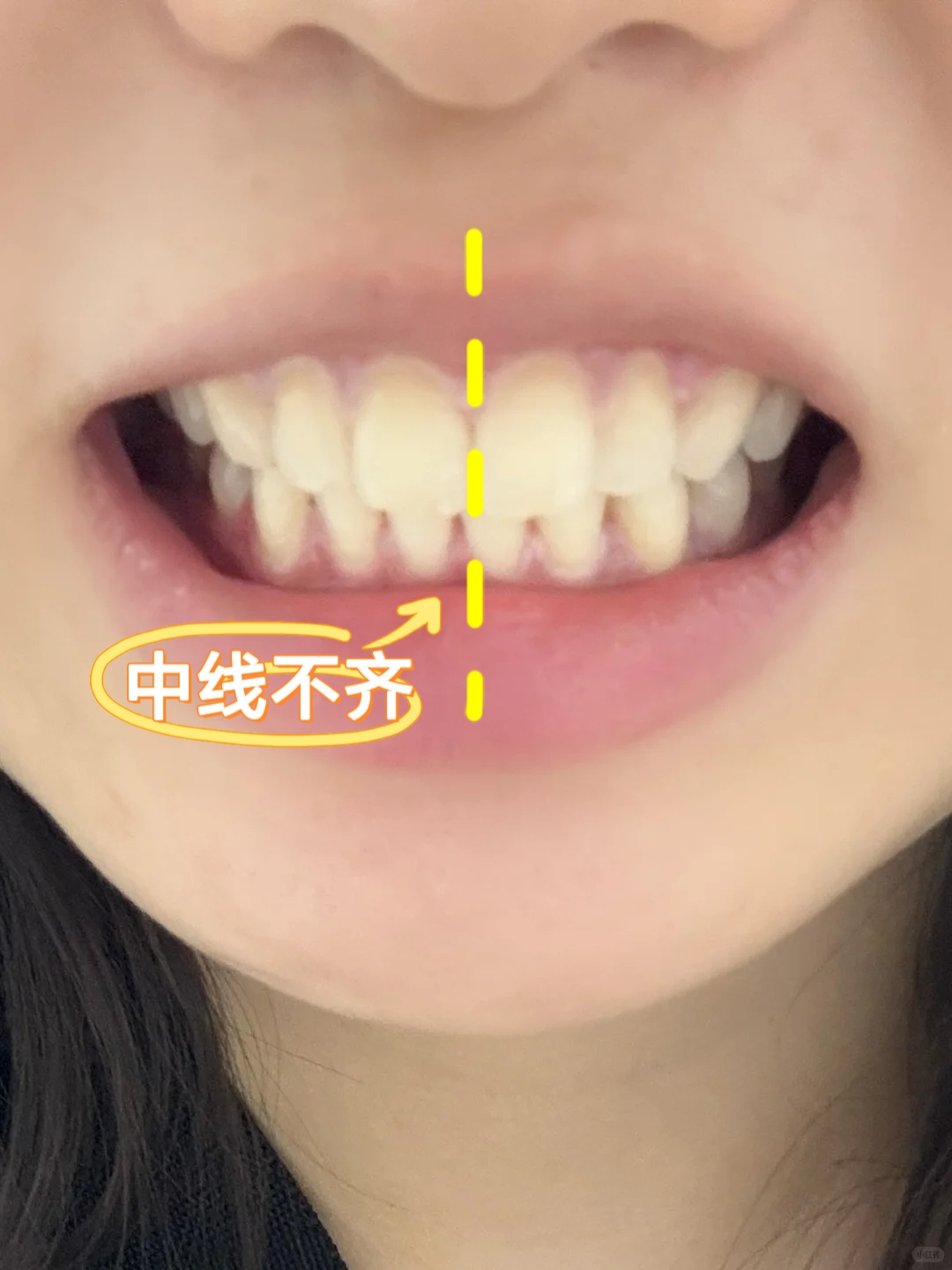 中线不齐矫正分享 告别歪牙尴尬！🌟