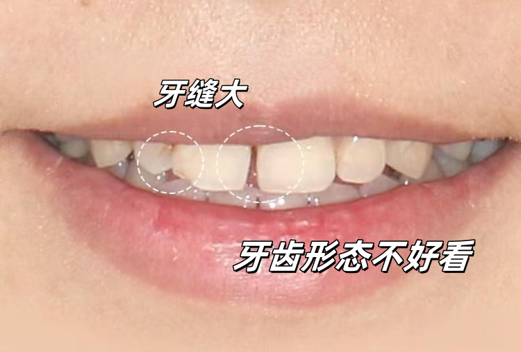 🦷从"尴尬露齿笑"到"人间水蜜桃"的变美小心机案例图片 2