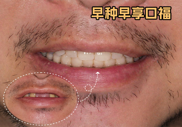 62岁老爸种牙记：从沉默到开怀大笑，我做了这三件事！