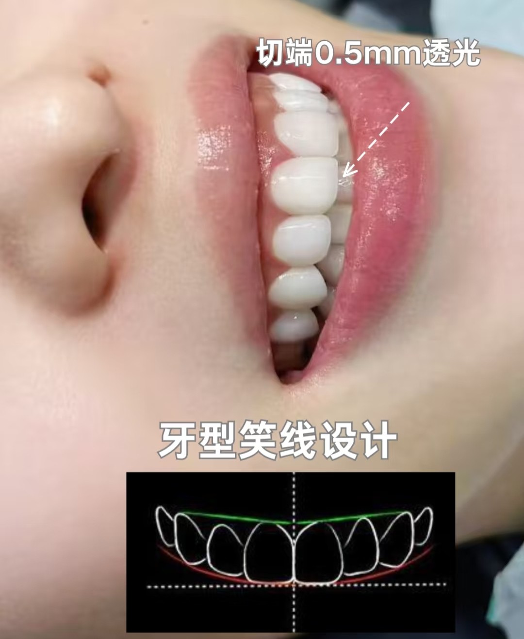 虎牙尖的天然萌感，被闺蜜追着问的牙齿小心机！👏案例图片 2