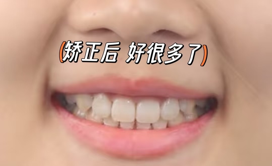 告别尴尬笑！我的牙齿矫正拯救计划✨案例图片 2