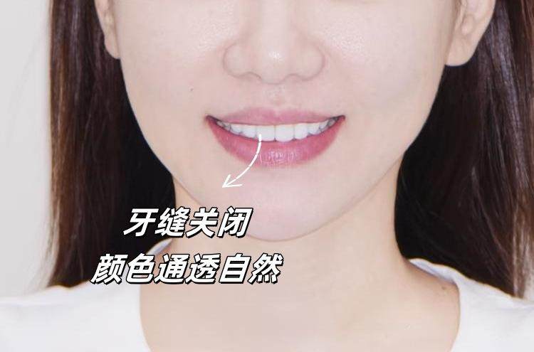 ✨后悔没早做的变美秘籍｜牙贴面初体验全记录！案例图片 1