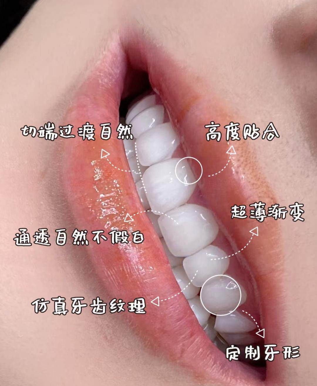 🌈我的超自然牙齿美白贴面分享｜宛若天生！案例图片 1