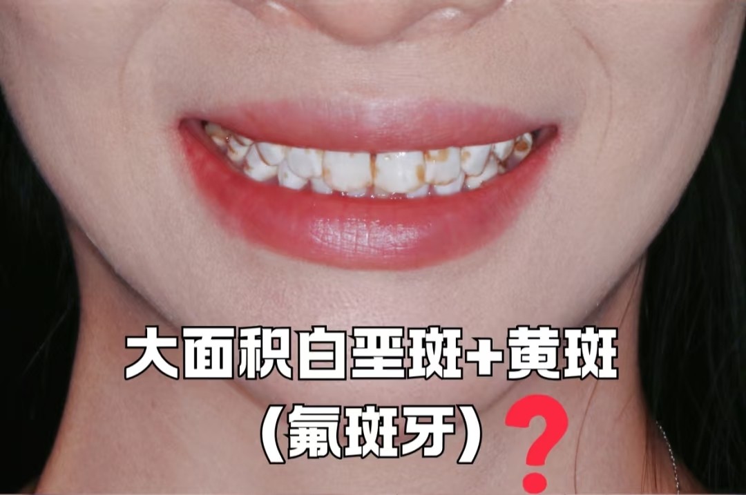 谁懂啊！牙齿大片白斑+黄斑，我的氟斑牙自救心得🦷✨
