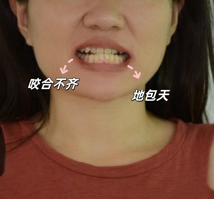 🌸我的隐形矫正全记录｜从自卑到自信的逆袭之路