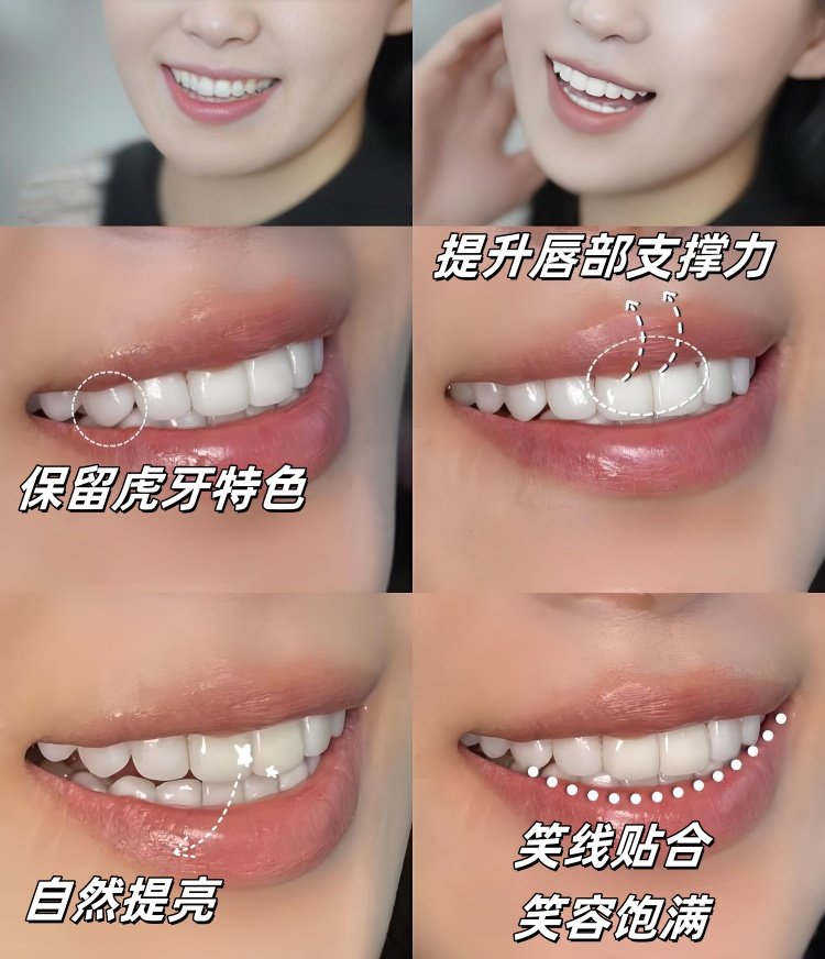 🦷全瓷贴面1年半真实反馈｜笑容逆袭的秘密被我找到了！
