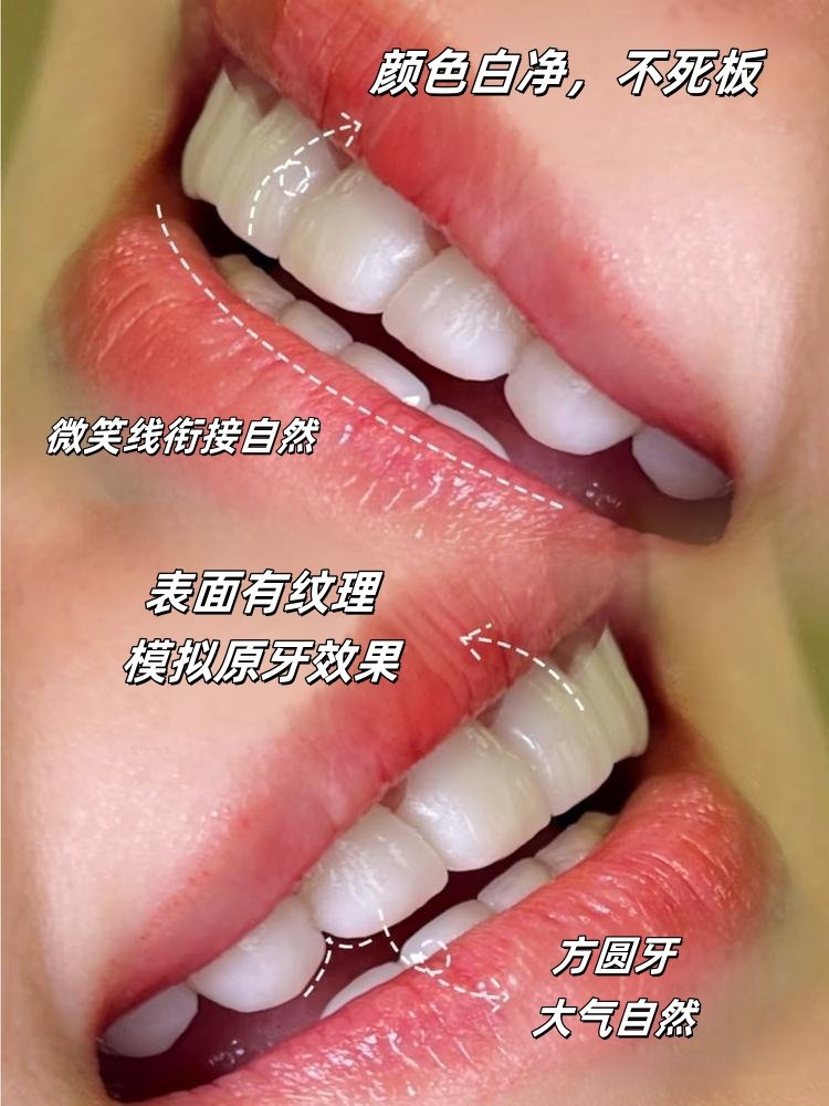 ✨拒绝"次抛牙"！牙贴面显假？这些细节你必须知道！