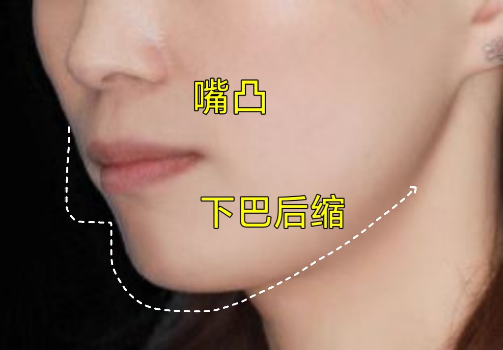 嘴凸矫正2年变化，这些心得想告诉你✨