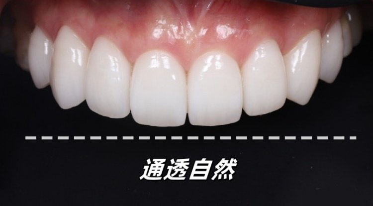 26岁牙套女孩的黑三角自救记｜从&ldquo;漏风笑&rdquo;到&ldquo;妈生感笑线&rdquo;的逆袭全记录案例图片 3