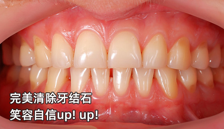 🦷人生第一次洗牙体验分享！原来牙齿可以这么干净✨