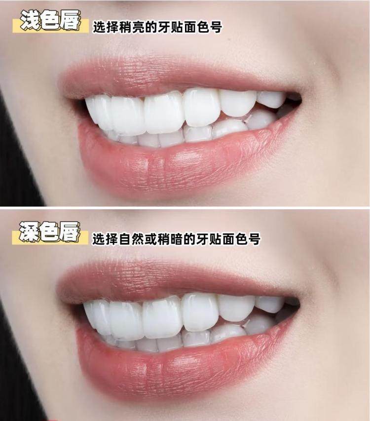 🌟28岁金融女的牙齿重生记｜从自卑到自信只需要这颗"兔牙"🌟案例图片 2