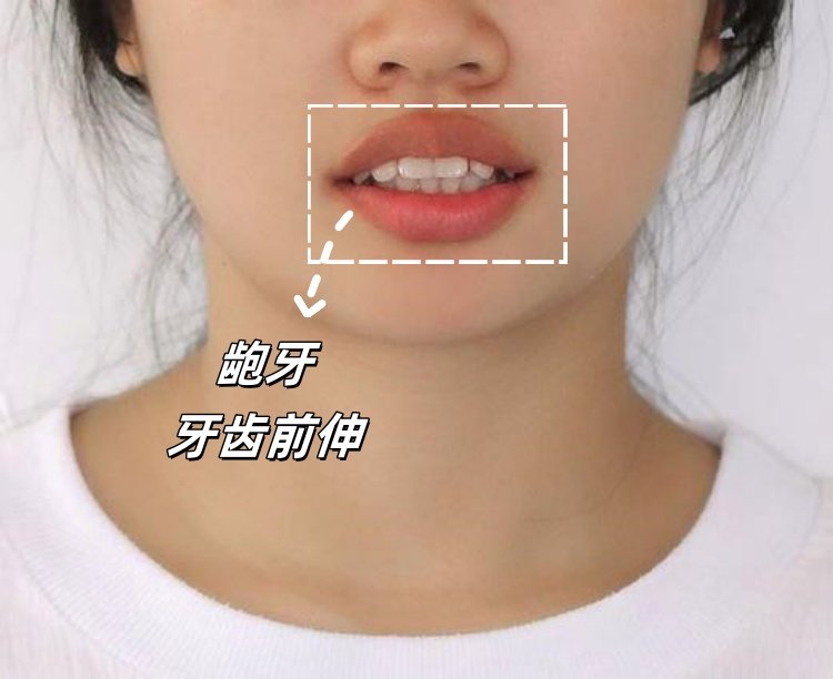 💫23岁龅牙女孩隐形矫正全记录｜从"凸嘴妹"到"侧颜杀"的逆袭之路案例图片 2