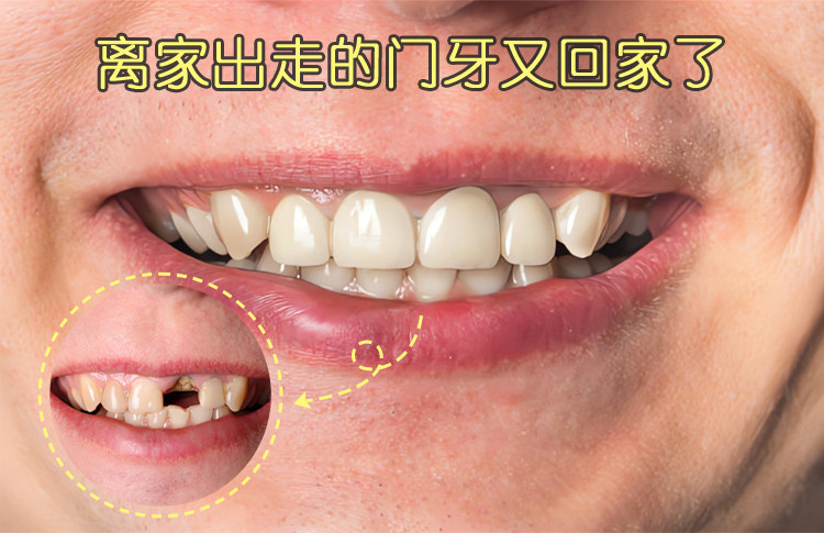 🔥种牙5个月！门牙重生记！