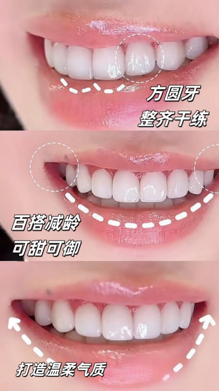 🔥被嘲笑的露龈笑，如今竟成高级感密码？案例图片 2