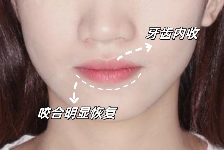 矫正15个月｜龅牙+嘴凸+智齿危机&rarr;侧颜杀的逆袭史