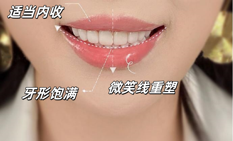 💄32岁姐姐的微笑逆袭记｜牙齿贴面让我重获「妈生感」笑颜✨