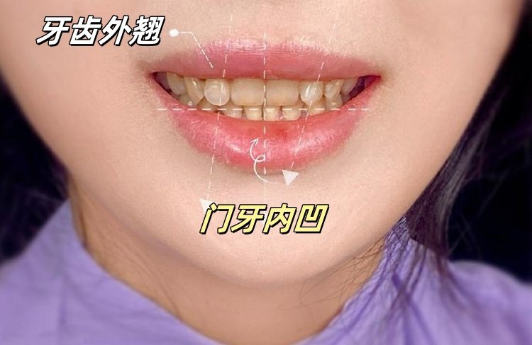 💄32岁姐姐的微笑逆袭记｜牙齿贴面让我重获「妈生感」笑颜✨案例图片 2