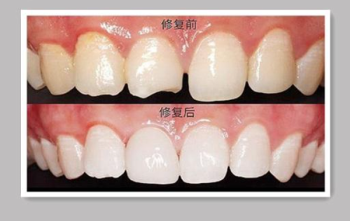 总结:选对牙医,就选呼和浩特天牙口腔门诊部吴泽宇医生