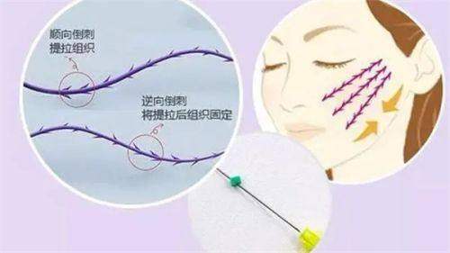 现在参加绍兴维美美容医院线提升活动划算不?