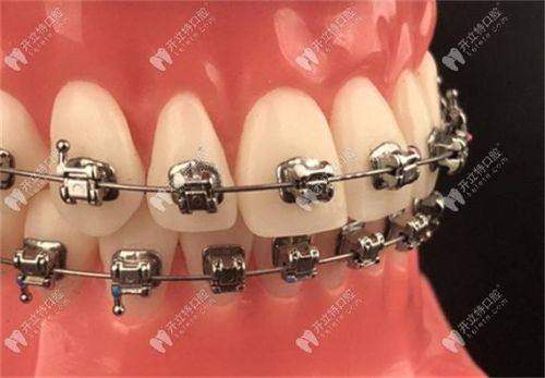 呼和浩特天牙口腔診所的金屬托槽矯正技術如何？
