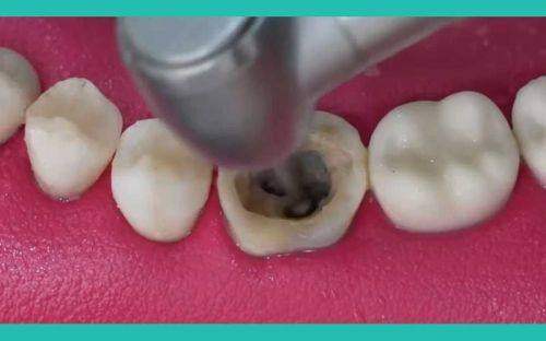 呼和浩特天牙口腔診療部陳振華根管治療可信嗎？真實案例揭曉其技術靠譜程度！ 