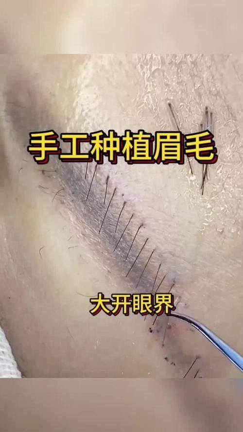 郑州曙光植发的眉毛种植技术优势