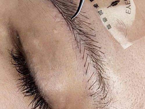 郑州曙光植发价格大揭秘