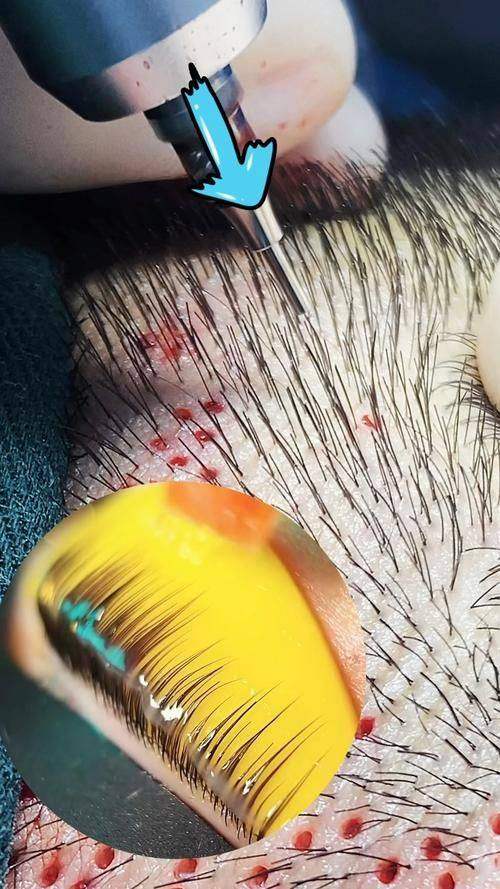 汪正伟医生:经验多的植发骨干医生