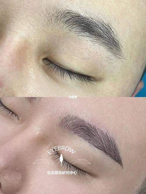 患者见证:郑州曙光植发汪正伟眉毛种植成效显著