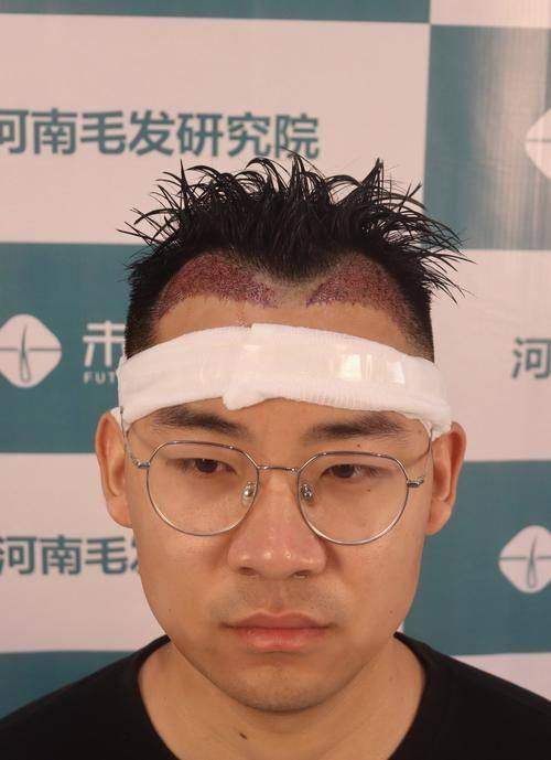 郑州曙光植发的贴心服务与术后保护