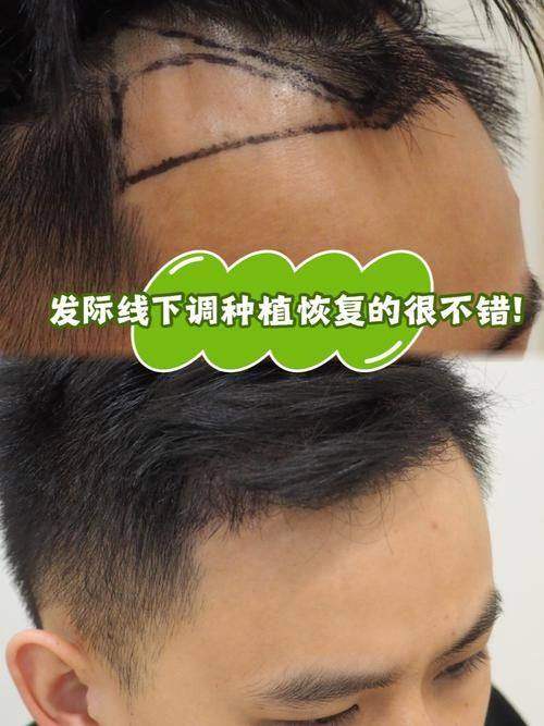 汪正伟医生:经验多的植发骨干医生