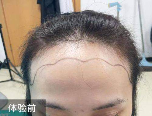 韩国精良植发技术在郑州曙光的应用