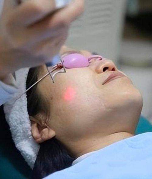 绍兴维美美容医院皮秒激光真实案例分享，做过的人皮肤真能变光滑？效果究竟咋样？ 