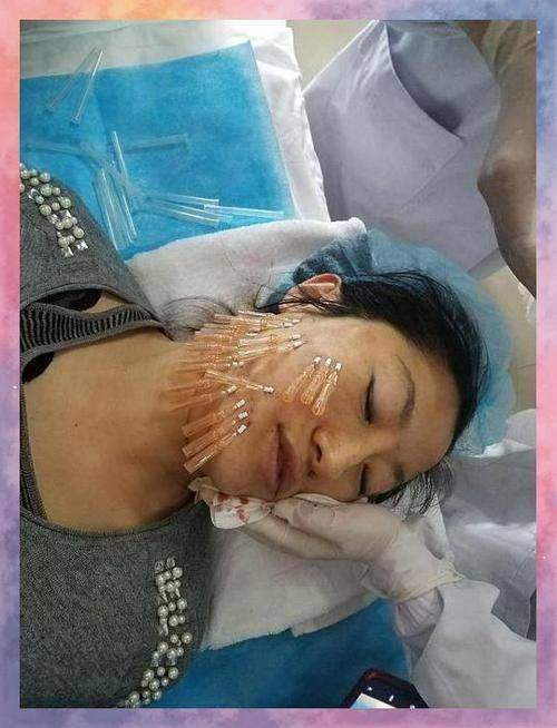 绍兴维美美容医院线雕2026年优惠活动来袭，做线雕有啥好处？现在参加划算不？一文解答！ 