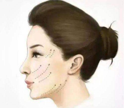 绍兴维美美容医院线提升的好处大盘点