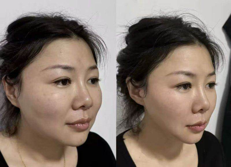 郑州曙光植发收费标准出炉！价格合理让你轻松拥有浓密秀发，植发不用再纠结！ 