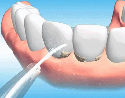 智齿拔除相关知识及实例