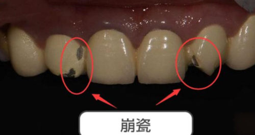 苏州拜博口腔诊所烤瓷牙真实案例分享，看看做烤瓷牙后牙齿变美、咀嚼变好是啥体验！ 