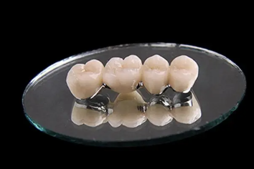 烤瓷牙的优势与适用人群