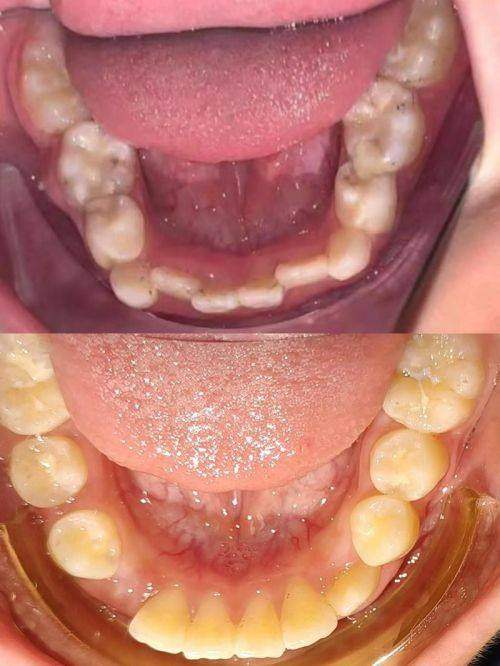 苏州拜博口腔诊所儿童早期矫治真实案例分享，看看孩子牙齿问题是如何轻松解决的！ 