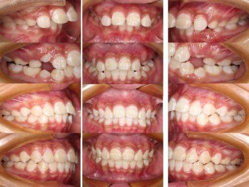 苏州泰康拜博口腔儿童早期矫治的优势