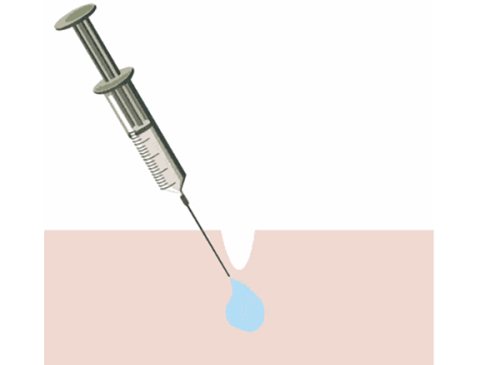 曾涉及的争议手术——小腿肌肉阻断术