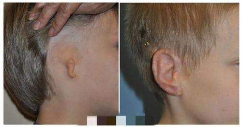 河南郑州整形美容医院张正文教授小耳再造能相信吗？放心，经验丰富技术好值得托付