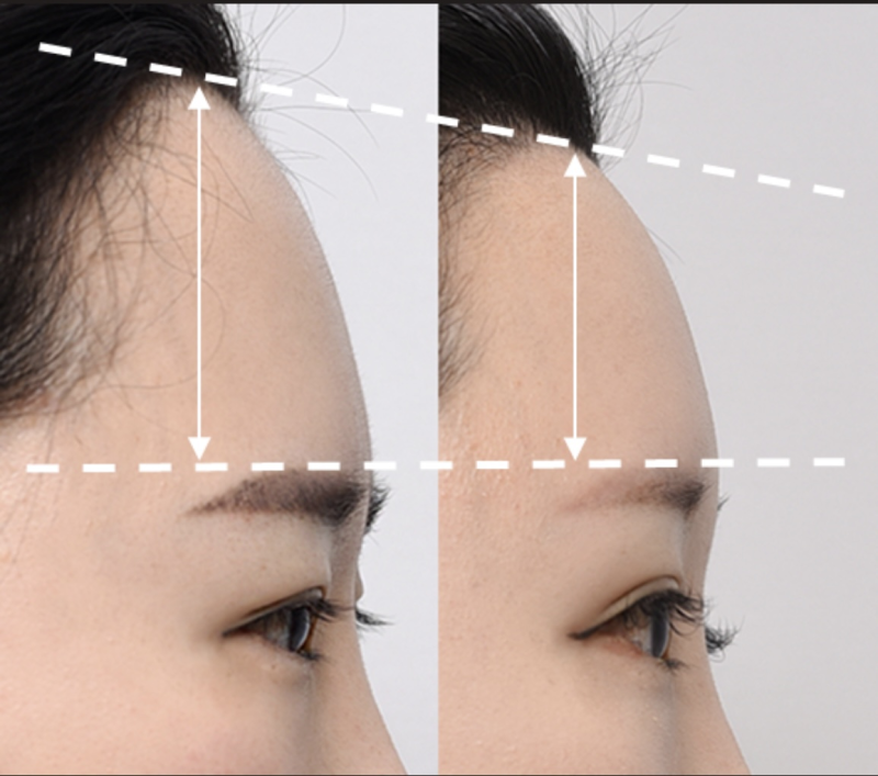 佛山君美整形美容医院暑期特别优惠活动